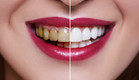שיניים צהובות (צילום: shutterstock)