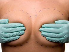 שרטוט על חזה אישה לקראת ניתוח (צילום: istockphoto)