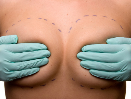 שרטוט על חזה אישה לקראת ניתוח (צילום: istockphoto)