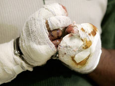 ידיים פצועות חבושות (רויטרס) (צילום: רויטרס)