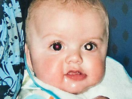 ילד עם עין אדומה (צילום: דיילי ניוז)
