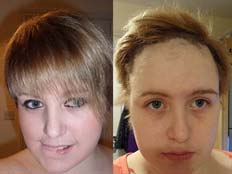 נערה בריטית ששיערה נשר - לפני ואחרי (צילום: דיילי מייל)