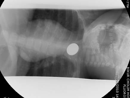שקל בגרון - בצילום הרנטגן (צילום: ביקור חולים)