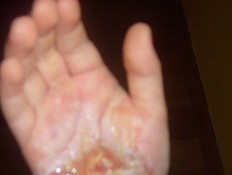 ילדה שמתקלף לה העור כשהיא נפצעת (צילום: MailOnline)