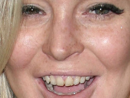 השיניים של לינדזי לוהן