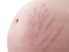 סימני מתיחה בהריון (צילום: istockphoto)