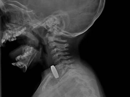 צילום הרנטגן של הפעוטה והמגנט (צילום: דוברות רמב"ם)