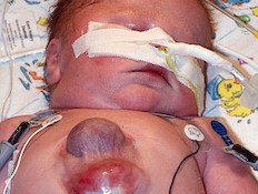 ילד שנולד עם לב מחוץ לגוף (צילום: dailymail.co.uk)