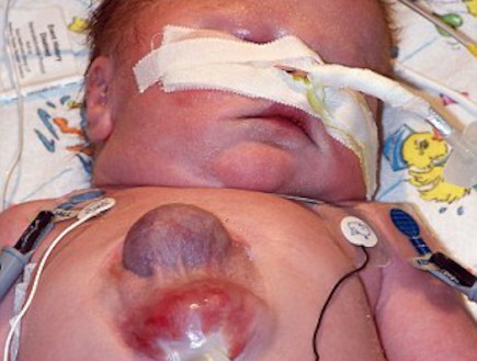 ילד שנולד עם לב מחוץ לגוף (צילום: dailymail.co.uk)