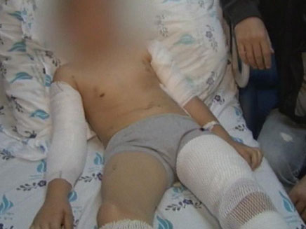 בן ה-10 שהותקף על ידי כלבי אמסטף (צילום: חדשות 2)