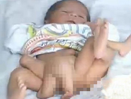 תינוק עם שש רגליים (צילום: nation.com.pk)