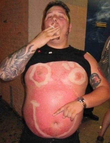 בחור שרוף בשמש עם פרצוף סמיילי (צילום: צילום מסך daily mail)