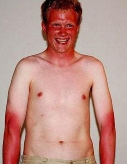 בחור שנשרף בשמש (צילום: צילום מסך daily mail)