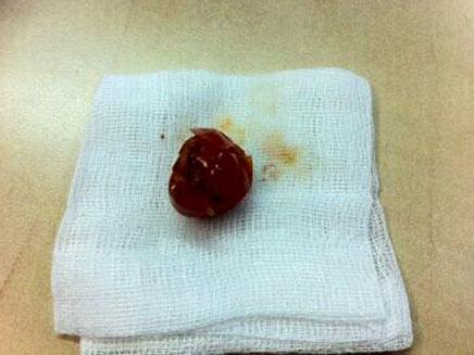 עגבנית השרי שהוצאה מריאותיו של הילד, היום (צילום: בית חולים רמב"ם)