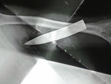 סכין נעוצה בזרוע של לוחם גורקה (צילום: kentonline.co.uk)