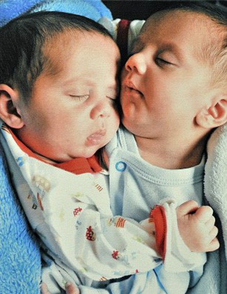 תאומים סיאמיים - חסאן וחוסיין תינוקות (צילום: צילום מסך daily mail)