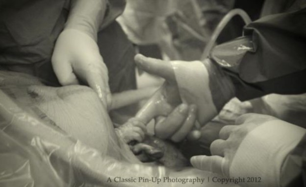 תינוקת צולמה בניתוח קיסרי