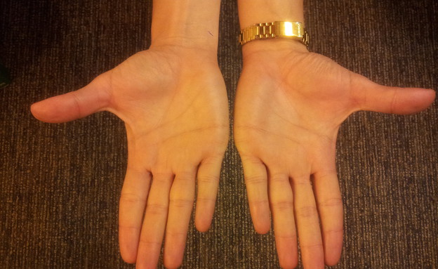 כפות הידיים של י' (צילום: תומר ושחר צלמים, צילום ביתי)