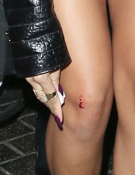 ריהאנה פצועה (צילום: noon)