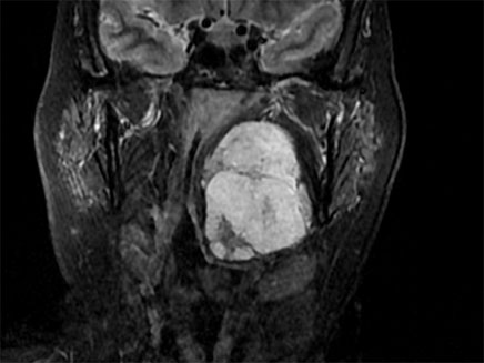 כריתת הגידול באמצעות רובוט (צילום MRI)