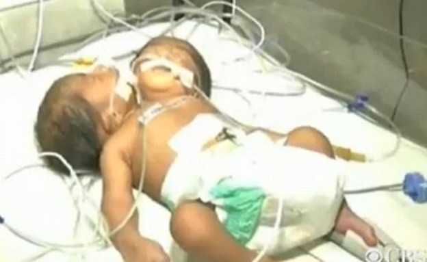 תינוק עם שני ראשים נולד בהודו (צילום: dailymail.co.uk)