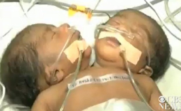 תינוק עם שני ראשים נולד בהודו (צילום: dailymail.co.uk)
