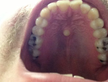 שן שצומחת במרכז הפה (צילום: mirror.co.uk)