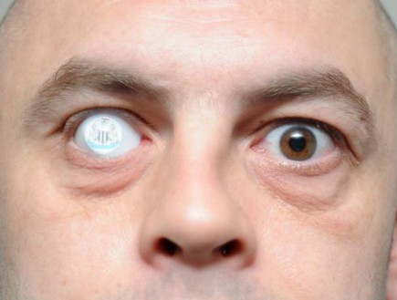 אוהד ניוקאסל עם עין תותבת (צילום: dailymail.co.uk)
