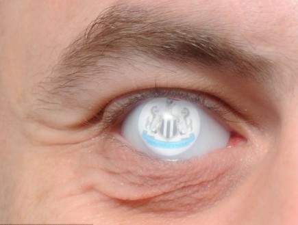 אוהד ניוקאסל עם עין תותבת (צילום: dailymail.co.uk)