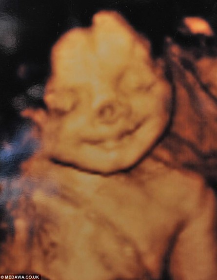 ילדה עם כתם לידה על האף (צילום: dailymail.co.uk)