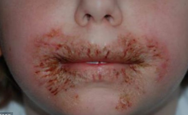 ילדה עם תגובה אלרגית למגבונים (צילום: MailOnline, צילום מסך)