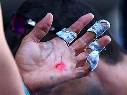 כפות הידיים הפצועות של נדאל  (צילום: ספורט 5)