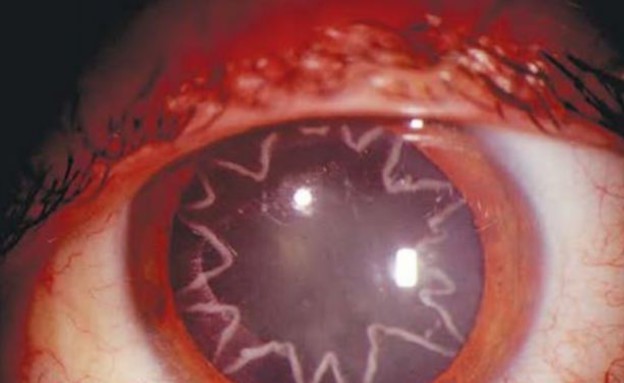 כוכבים בעיניים (צילום: The New England Journal of Medicine)