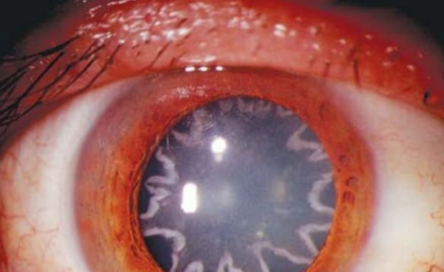 כוכבים בעיניים (צילום: The New England Journal of Medicine)