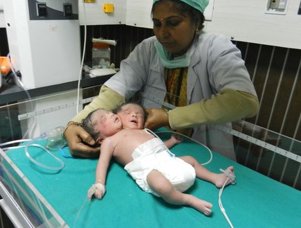 תינוק עם שני ראשים (צילום: אסיה פרס)