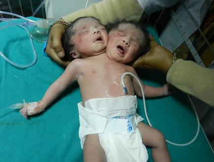 תינוק עם שני ראשים (צילום: אסיה פרס)