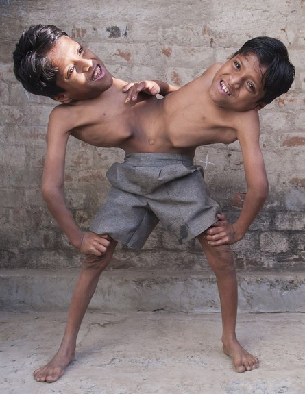 תאומים סיאמיים (צילום: Barcroft India)