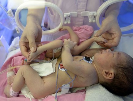 תינוק עם 8 ידיים ורגליים (צילום: Ynagcheng Evening News)