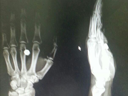 צילום הרנטגן של העובד שנפצע (צילום: יהודה ביכלר)