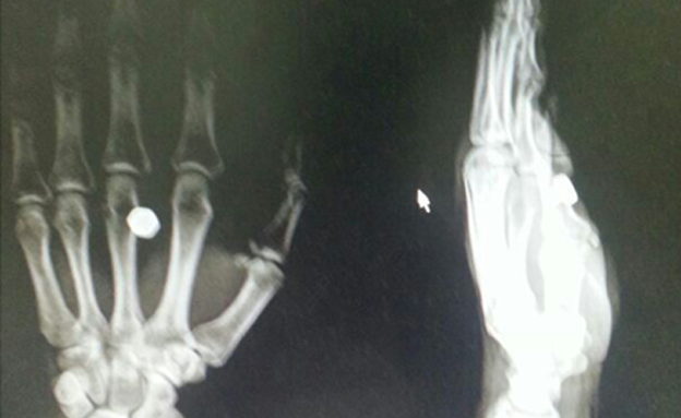 צילום הרנטגן של העובד שנפצע (צילום: יהודה ביכלר)