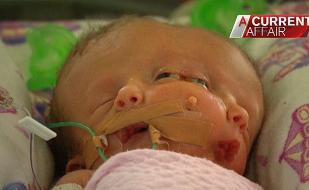 תינוק פנים כפולות (צילום: Channel 9)