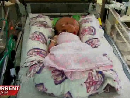 תינוק פנים כפולות (צילום: Channel 9)
