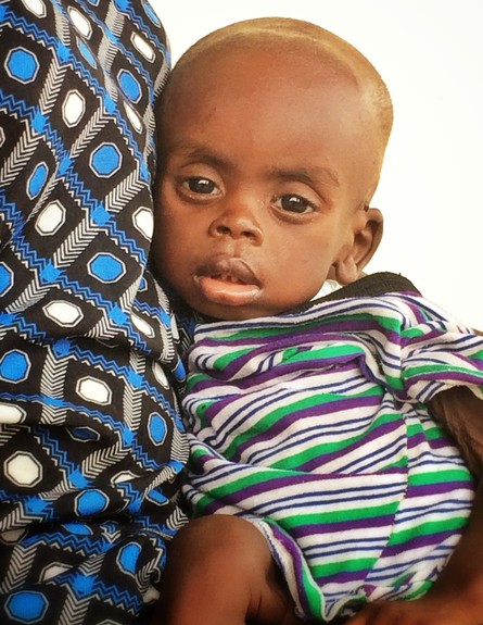 גוק תינוק בן 9 חודשים הסובל מתת תזונה בזרועות אמו (צילום: UNICEF)