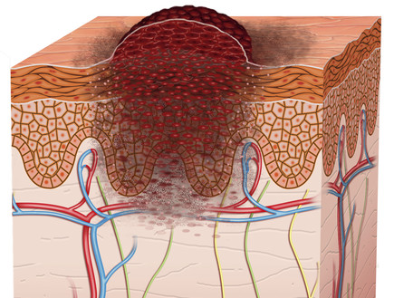 שרטוט של התפתחות מלנומה על פני העור (צילום: thinkstock)