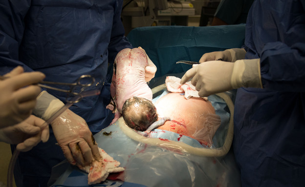 ניתוח קיסרי בתמונות (צילום: דנה אופז, מערכת מאקו הורים)