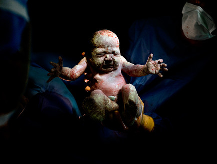 כריסטיאן ברתלו - לידה תינוק קיסרי (צילום: christianberthelot.com)