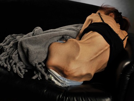 רייצ'ל פארו חולת אנורקסיה (צילום: casian)