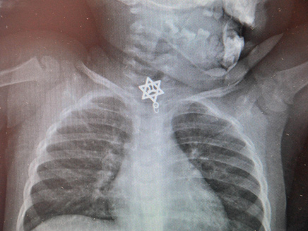 צילום הרנטגן הראה: הפעוטה בלעה מגן דוד (צילום: דוברות בי