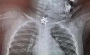 צילום הרנטגן הראה: הפעוטה בלעה מגן דוד (צילום: דוברות בי"ח קפלן)