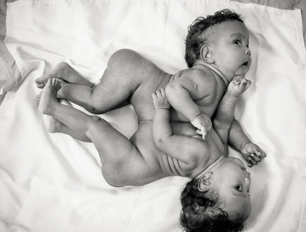 תאומות סיאמיות (צילום:  Mateus André Photography)